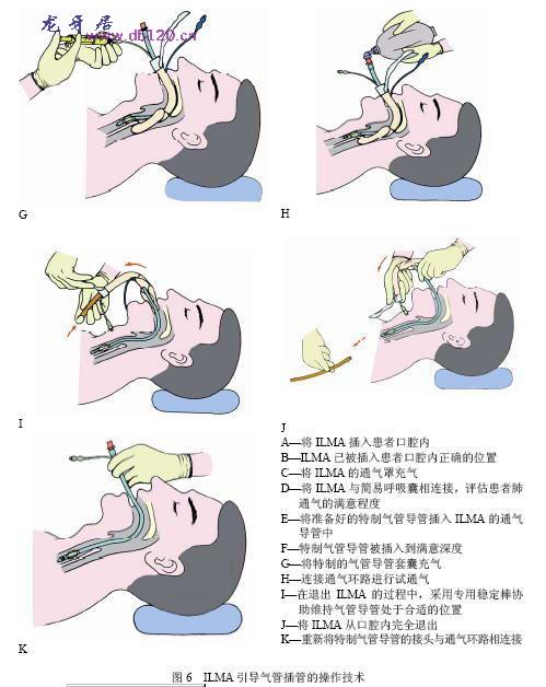 气管插管如何开拓国际市场?